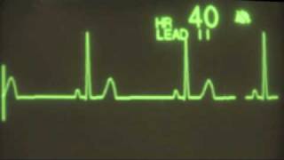 Sinus Bradycardia  ECG Training [upl. by Martie]