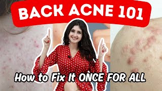 How To Get Rid Of BACK ACNE At Home  3 Best Back Acne Treatments [upl. by Cozza]