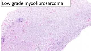 A guide to low grade myxoid sarcomas [upl. by Einhpets]