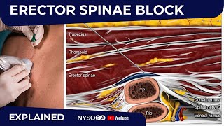 Erector Spinae Plane Block  Regional anesthesia Crash course with Dr Hadzic [upl. by Wilterdink]