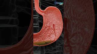 Understanding Hemorrhagic Gastric Ulcers [upl. by Aubry620]