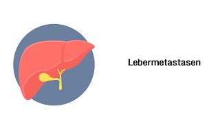 Lebermetastasen  Erkrankungen von Leber Gallenwege und Pankreas [upl. by Adnalahs]