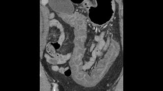 Pancolitis  acute onset  CT findings [upl. by Milissa]