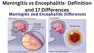 Meningitis vs Encephalitis Definition and 17 Differences [upl. by Aslam532]