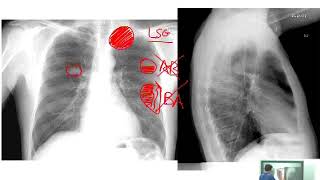 Dossier PAE  Pneumologie 03 [upl. by Ednalrim504]