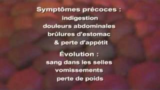 Cancer de l estomac Symptômes Définition Diagnostic Traitements [upl. by Averi]