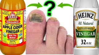 What is Better For Toenail Fungus  White Vinegar or Apple Cider Vinegar [upl. by Sanburn]