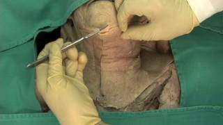 12 Step 1 Removal of skin and exposure of platysma muscle [upl. by Fortunio]