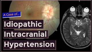 Idiopathic Intracranial Hypertension [upl. by Yeltnerb]