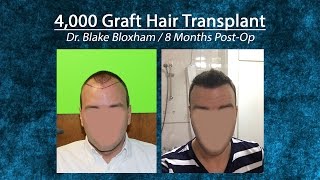 4000 Graft Hair Transplant on UK Patient Feller and BloxhamGreat NeckLong IslandNY [upl. by Deeraf]