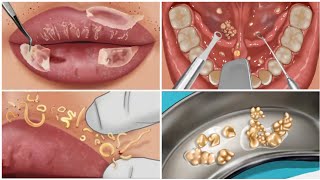 ASMR  Tonsil stone removal animation  Tonsil stone ASMR animation  Tonsil stone ASMR [upl. by Nanci]