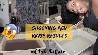 ACV RINSE RESULTS on my LOCS I WAS SHOCKED [upl. by Madson]