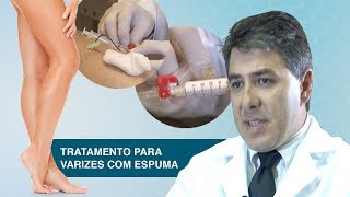 Tratamento para varizes com Espuma [upl. by Kcarb]