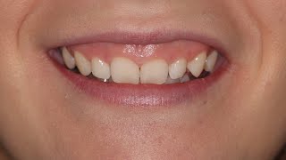 Sonrisa Gingival y Sobremordida Extrema con Minitornillo Extreme Gummy Smile and Overbite Tads [upl. by Bal]