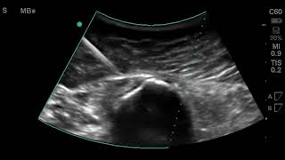 Hip Ultrasound Subglute Max Bursa Injection [upl. by Barbur]