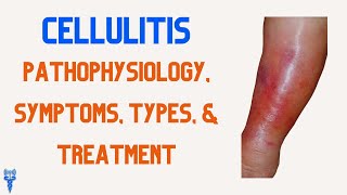 CELLULITIS Pathophysiology Types Treatment Symptoms amp Nursing Interventions [upl. by Darsie167]