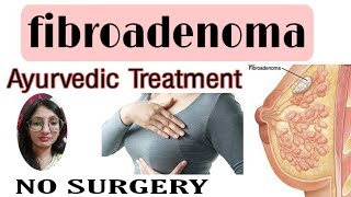 fibroadenoma breast मे गाँठ Ayurvedic treatment [upl. by Yvehc303]