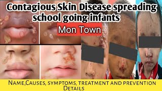 Contagious Skin Disease spreading in Mon Sadar what is this diseaseSymptomstreatment prevention [upl. by Edward]