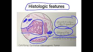 calcifying epithelial odontogenic tumour [upl. by Assiralc200]