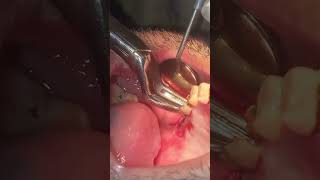 Extraction of upper right second molar roots [upl. by Atirrehs]