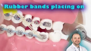 How to put the rubber band on placing on the orthodontic elastics between upper amp lower jaw [upl. by Arodnap]