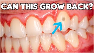 Can Tooth Enamel Grow Back How To Prevent Enamel Erosion [upl. by Rehsu]