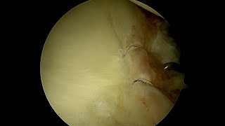 Probing the Labrum Assess Its Stability Following Arthroscopic Repair [upl. by Valleau924]