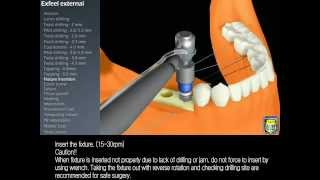 MegaGen  3D ExFeel External [upl. by Ahsha]