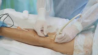 Behind The Scenes Local Anesthetic before Laser Treatment on Varicose Veins [upl. by Eintroc]