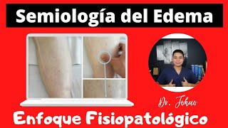 Semiología del EDEMA  Enfoque Fisiopatológico [upl. by Tiphany269]