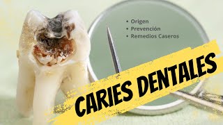 Todo sobre las Caries dentales [upl. by Leehar253]