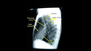 Lateral View of A Chest Xray  Definition structures and Uses [upl. by Landbert]