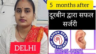 EARDRUM 5 MONTHS AFTER ENDOSCOPIC EAR SURGERY 👂 ashokbest jaipur 88245 44291 [upl. by Silden]