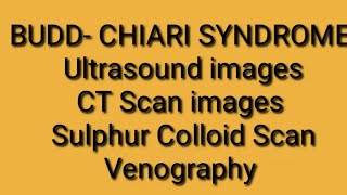 BuddChiari Syndrome on Radiology [upl. by Beilul]