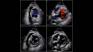 Ruptura de septum interventricular en SICA [upl. by Eselahc]