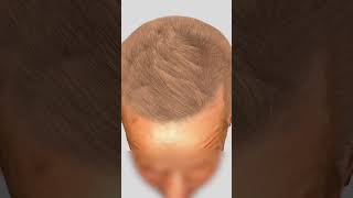 New way to count grafts for hair restoration TrichoLAB restorehair hairlinerestoration [upl. by Lounge746]