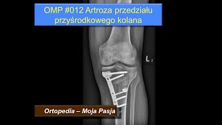 Artroza kolana Zmiany zwyrodnieniowe przedziału przyśrodkowego stawu kolanowego  OMP 012 [upl. by Nylauqcaj]