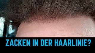 FUE HAARTRANSPLANTATION TÜRKEI vorher nachher 29 Wochen Update [upl. by Skipp6]