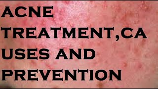 acne treatmentcauses and prevention [upl. by Beasley419]