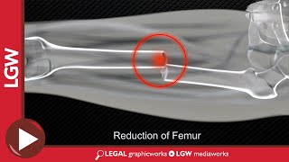 Midshaft Femur Fracture Intramedullary Nailing 3D Animation [upl. by Brigit]