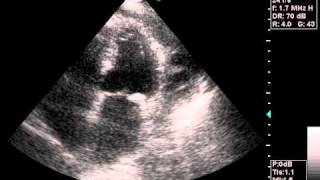 echocardiography pericardial effusionavi [upl. by Namar]