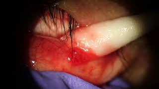 Chalazion Popped on inner eyelid w needle [upl. by Lordan]