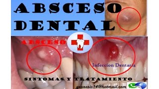 ABSCESO DENTAL [upl. by Amoihc]