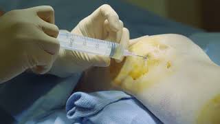 How to perform knee arthrocentesis [upl. by Aelrac]