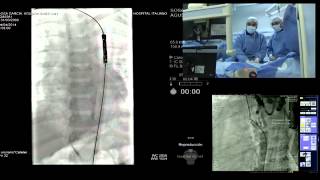 Caso en vivo pediátrico en SOLACI 2014 –Implantación de stent en coartación aórtica [upl. by Martinelli]