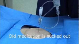 Intrathecal or Spinal Morphine pump or Baclofen pump refill procedure [upl. by Sanson]