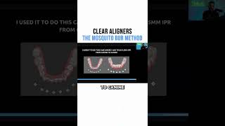 Clear Aligners The mosquito Bur Method [upl. by Yrrep]