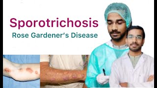 Sporotrichosis  Rose Gardeners Disease  Subcutaneous Mycosis [upl. by Aneba]