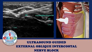 External Oblique Intercostal Ultrasound Guided Nerve Block [upl. by Clarita793]