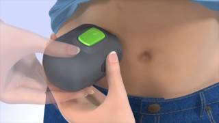 Medtronic  How to insert the Guardian Connect CGM [upl. by Aicilic]